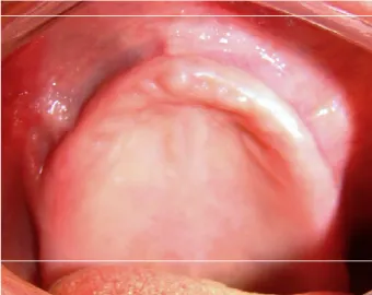 Figura 11. Hiperplasia fibrosa infamatória – exame intra-oral – pós operatório de 30 dias (retirado de  Batista et al., 2013)