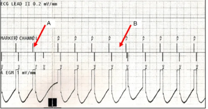 Figura 4. Ruído produzido pelo LAE e detectado pelo MP  (canal de marcas; sensibilidade 0,2mV) no período  refratá-rio do mesmo, que não gera inibição e reinício do ciclo de  estimulação (seta)