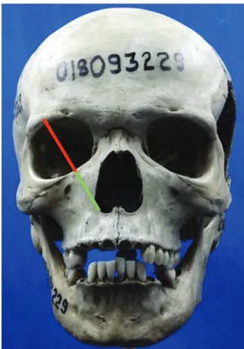 Fig. 2. Male (a) and female (B) skulls, from the same age group. in men the forehead is oblique, the glabella  and frontonasal suture are more pronounced, and the supraorbital rim is prominent