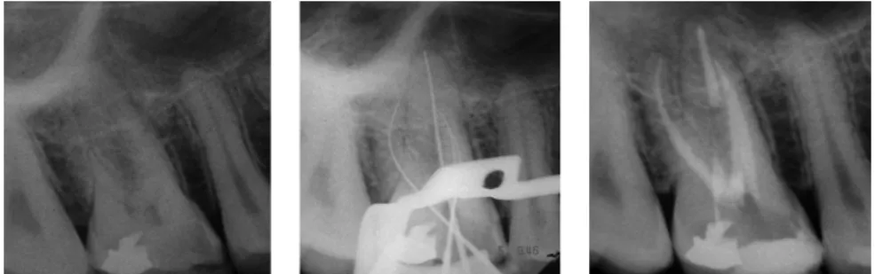 Figura 6. Tratamento endodôntico de molar superior com pulpite irreversível 