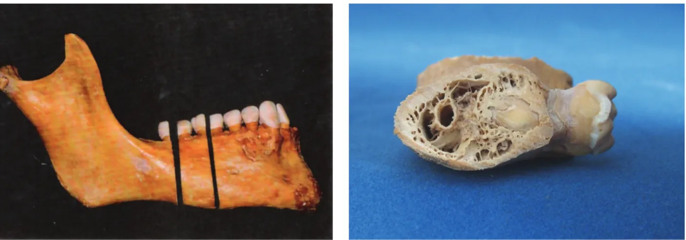 Figura 1. Cortes em primeiro e segundo molares Figura 2. Aspecto proximal mesial da mandíbula após o corte