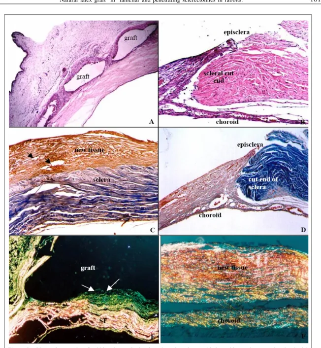 Figure 2 - Photomicrographs of rabbit sclera submitted to the scleroplasty with latex biomembrane and stained with Hematoxylin and Eosin (A e B), Masson trichrome (C e D) e Picrosirius (E e F)