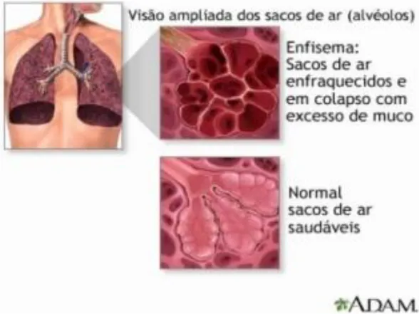 Figura 1: Esquema anatômico representativo de um alvéolo no enfisema e um alvéolo normal