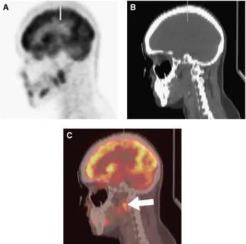 Figure 2 - (A) Sagittal PET image, (B) sagittal reformatted CT image, and (C) PET/CT  image with CT component in grayscale and PET image in red temperature color 