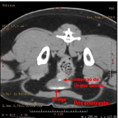 Figura I.C –Tomografia computadorizada pós-contraste em  corte  transversal,  da  região  abdominal  evidenciando  inserção do ureter direito na região do trígono vesical