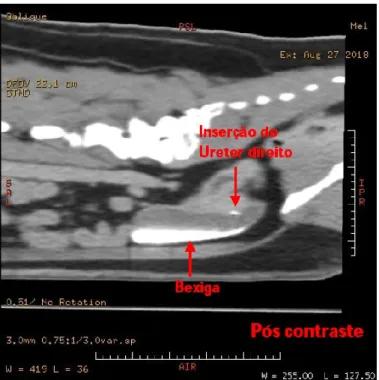 Figura  I.D  –Tomografia  computadorizada  pós-contraste  em  corte  sagital,  da  região  abdominal  evidenciando  inserção  do  ureter direito na região do trígono vesical