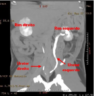 Figura I.F –Tomografia computadorizada pós-contraste em  corte dorsal, da região  abdominal  evidenciando dilatação  do ureter esquerdo, dilatação da pélvis renal esquerda