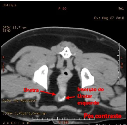 Figura I.H –Tomografia computadorizada pós-contraste em corte  transversal,  da  região  abdominal  evidenciando  inserção  do  ureter esquerdo na região da uretra