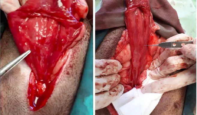 Figura  I.I  –  Imagem  intra-cirúrgica  onde  se  observa  (apontado  pela  pinça  cirúrgica)  a  abertura normal do orifício ureteral  direito com  saída de urina