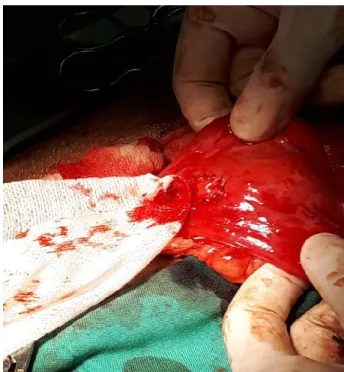 Figura I.L – Imagem intra-cirúrgica onde se observa  a  sutura  dos  bordos  do  novo  orifício  ureteral  com  pontos simples descontínuos