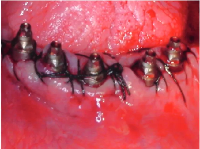 Figura 1. Aspecto clínico inicial Figura 2. Implantes colocados com esteticones apara- apara-fusados todos com cinta de 3 mm e sutura realizada