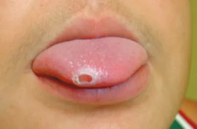 Figura 1. Cancro localizado em dorso de língua