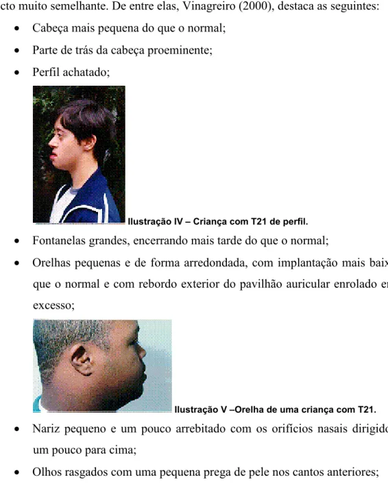 Ilustração V –Orelha de uma criança com T21.