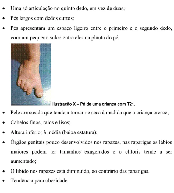 Ilustração X – Pé de uma criança com T21.