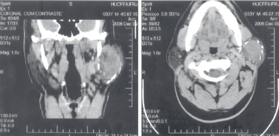 Figura 2A. Imagem axial e 2B. imagem coronal de uma sialotomografia com injeção do meio de contraste intraductal, permitindo delimitar com maior precisão toda lesão da glândula parótida esquerda