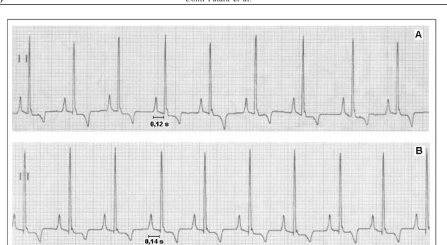 Figure 1 - A-Sinus Rhythm with 15 minutes of general anesthesia. B-After 30 minutes of general anesthesia, the animal had first degree atrioventricular block.