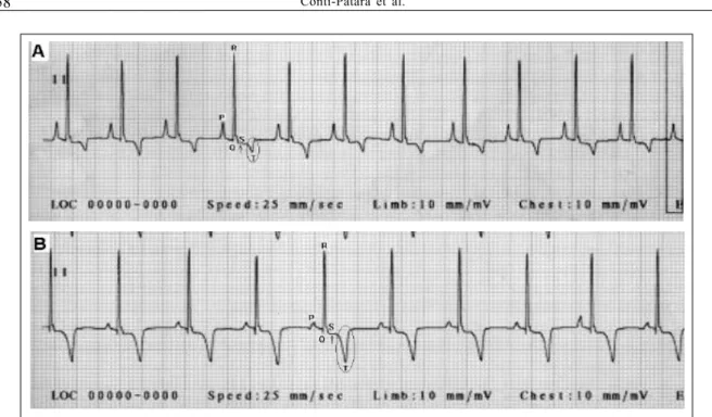 Figure 2 - A- An electrocardiogram with normal ST-segment and T-wave (DII, N, 25mm s -1 )