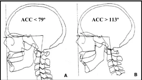 Figura  4  ângulo  crânio-cervical  diminuído  e  aumentado,  respectivamente.  (adaptado  de  Pollmann,  1997 ) 
