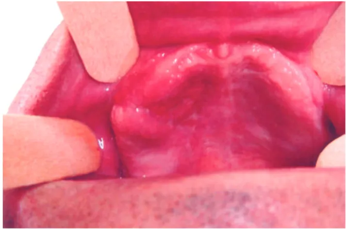 Figura 4. Período de 3 semanas de cicatrizaçãoFigura 3. Fechamento cirúrgico da fístula, através de retalho rotatório palatino e