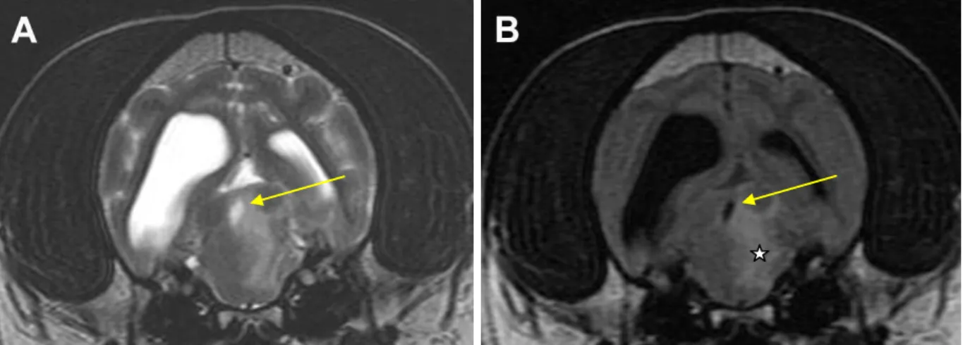 Figura 7 – Imagens de RM da forma focal de MEG. Em A: um corte transversal em T2 ao nível do mesencéfalo,  colículo caudal e córtex cerebral