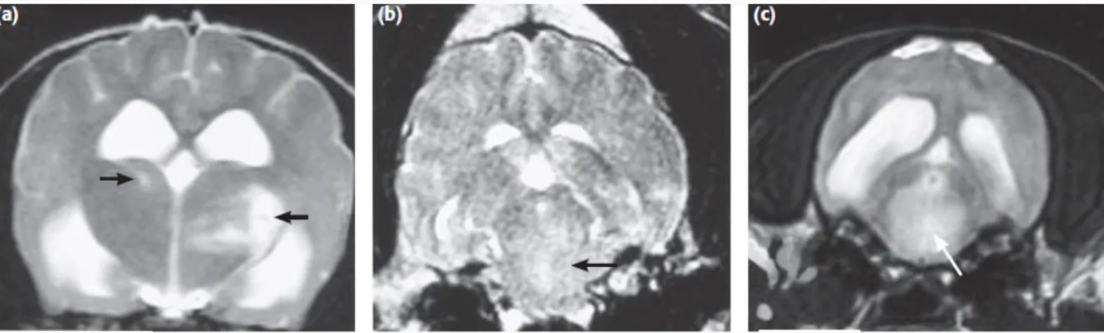 Figura  14  – Imagens transversais ponderadas em T2 do encéfalo de três cães distintos com  confirmação histológica de MEG