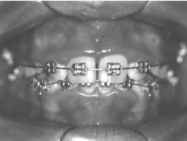 Figura  IV  – Hiperplasia gengival situada nos dentes anteriores superiores, na adolescente  portadora de aparelho ortodôntico fixo