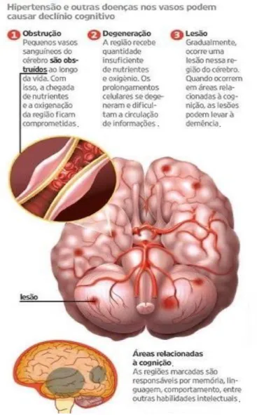 Figura 10- Demência vascular (Demência vascular, 2014) 