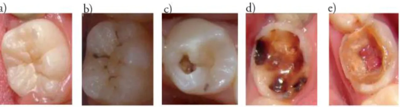 Figura 1  –  Evolução da cárie dentária 