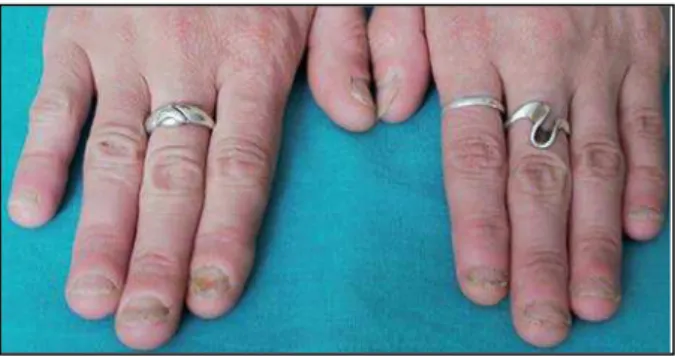 Figura 8: Lesões nas unhas devido a onicofagia (Adaptado de Pacan et al., 2003). 
