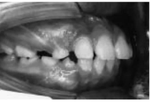 Figura 11:  Selamento labial  associado a respiração bucal  (Adaptado de Yamaguchi et al.,  2003)