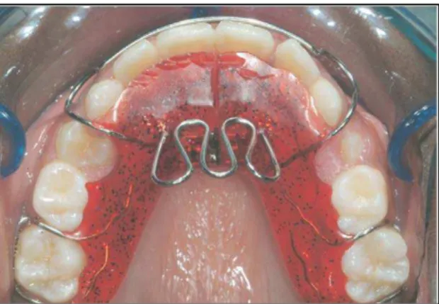 Figura 13: Aparelho removível com grelha lingual (Adaptado de Cozza et al., 2008). 