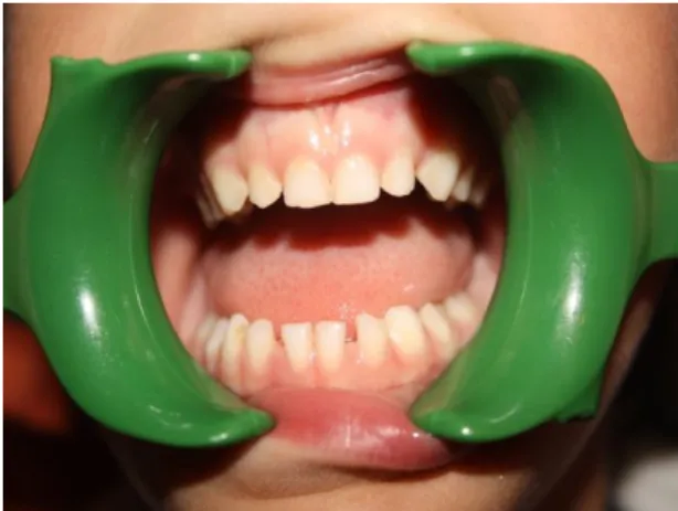 Figura 5- Dentição decídua. Cedida: Queirós, M.G. 