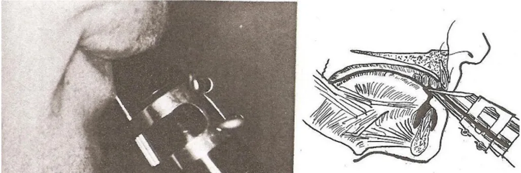 Figura 2 – Posição da boca e da mandíbula durante a prática de clarinete. (Herman, 1974) 
