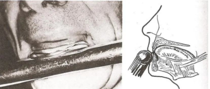 Figura 4 – Posição da boca e mandíbula, durante a prática de flauta transversal. (Herman, 1974) 