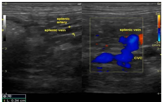 Figure 2 - Color Doppler ultrasonography showing shunting vessel between esplenic vein and caudal vena cava.