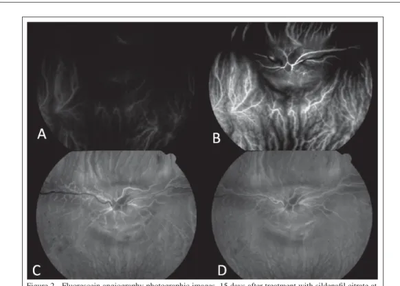 Figure 2 - Fluorescein angiography photographic images, 15 days after treatment with sildenafi l citrate at  a dose of 3.5mgkg -1  in a male New Zealand breed rabbit
