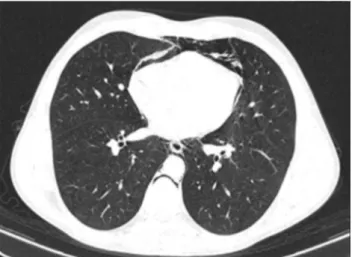 Figura 1: Raio X pneumomediastino