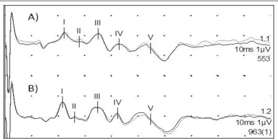 Figure 2 shows the auditory evoked  potential obtained from an adult horse. Table 1 shows  the mean, minimum, and maximum values and  standard deviations of waves I, II, III, IV, and V and  of interpeaks I-III, IIII-V, and I-V for the 21 animals  at an int