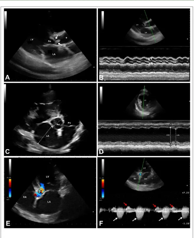 Figure 1 - A. Longitudinal echocardiographic image obtained from the right parasternal window, showing dysplastic and fused aortic  valve cusps (arrows), resulting in outflow obstruction and post-stenotic dilation ( * ); B