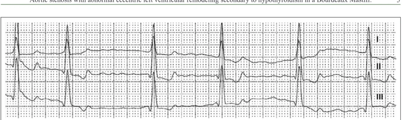 Figure 2 - Three-lead electrocardiogram depicting an irregularly irregular rhythm with no P waves, which is diagnostic for atrial fibrillation.