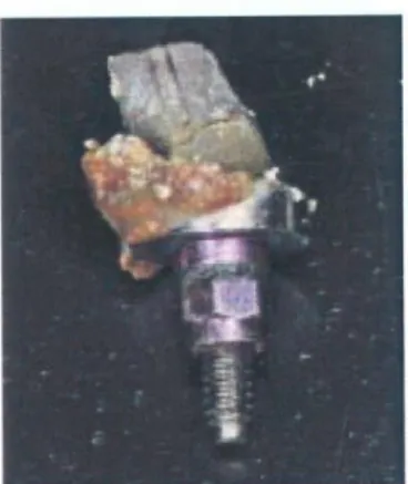 Fig. 9: Abutment with undetected excess cement after removal (Korsch et al. 2015/ 7 