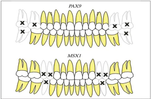 Figura 1. Padrão de ausências dentárias nos genes PAX9 e MSX1. 