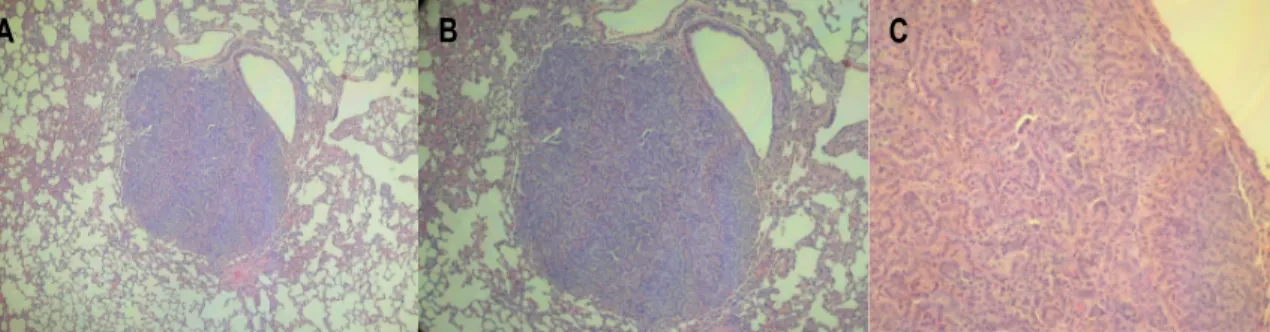 Figure  6:  Lung  metastasis  in  a  male  ICR  mouse  treated  with  N-butyl-N-(4- N-butyl-N-(4-hydroxybutyl)nitrosamine with invasive urothelial carcinoma (H&amp;E) (A: x100; B: 