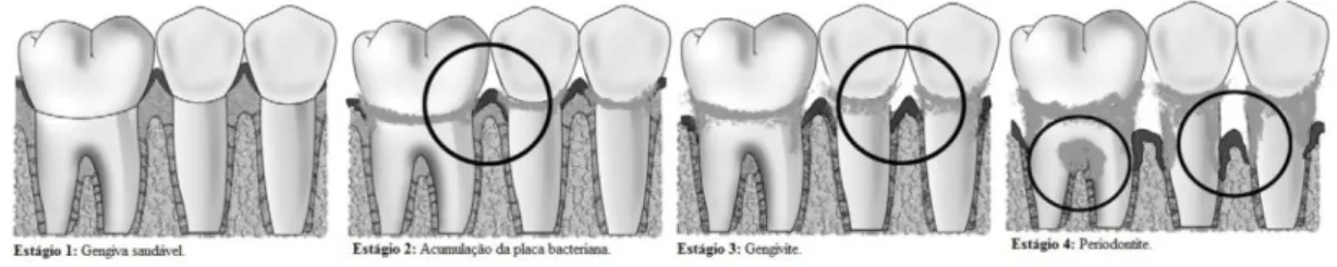 Figura 4. Representação da evolução de uma gengiva saudável até periodontite (Jain et al., 2008).