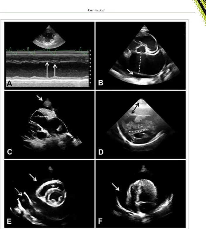 Figure 2 - Echocardiographic images showing (A) the impairment in cardiac contractility evidenced by the arrows, in which the left  ventricle cavity does not suffer much change in its diameter comparing systole (short arrow) and diastole (long arrow),  in 