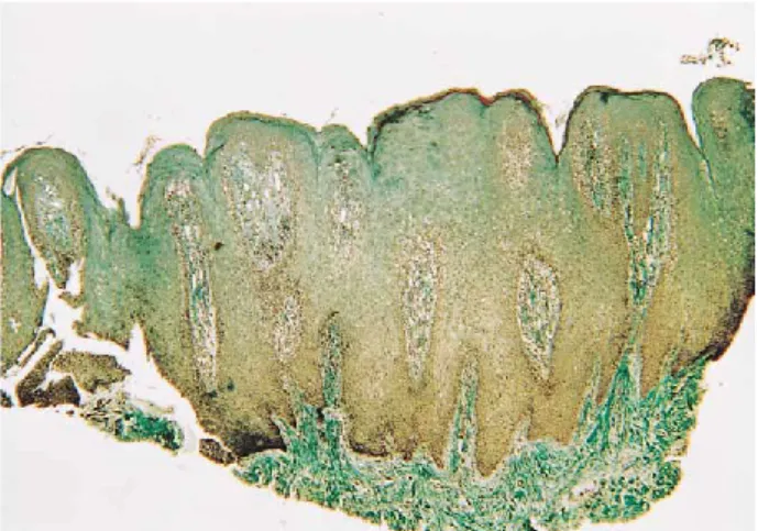 Figura 7: Adapatado de: hiperplasia das células do épitélio (Silva et al., 2001) 