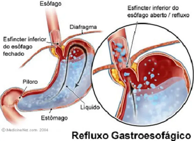 Figura 9: Adaptado de: mecanismo do esfincter inferior de esófago  http://www.gastrovideo.com.br/novo/hiato_refluxo.php 