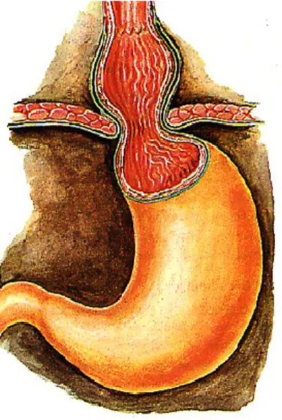 Figura 11: Adaptado de: hérnia Hiatal deslizante (tipo 1)  http://hepatoweb.com/anatomobase/images/oesophage9.j peg