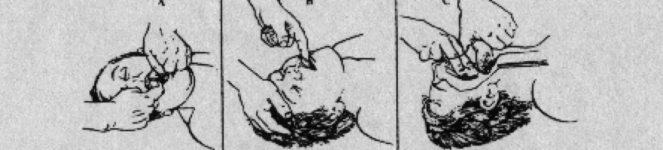 Figura 7. Três métodos de forçar a abertura da boca para limpeza. A) manobra dos «dedos  cruzados», para o maxilar inferior moderadamente relaxado; B) manobra do «dedo atrás dos  dentes» para o maxilar inferior encaixado; C) manobra da «elevação da língua 