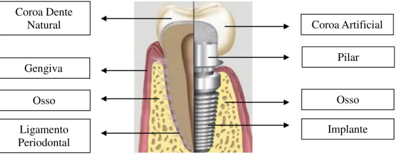 Figura 1- Esquema comparativo entre o sistema anatómico do dente e do implante (Ref. 